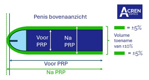 penis verlenging